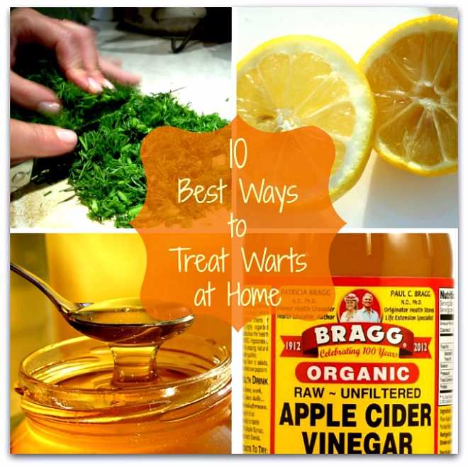 10 Best Ways to Treat Warts at Home Naturally