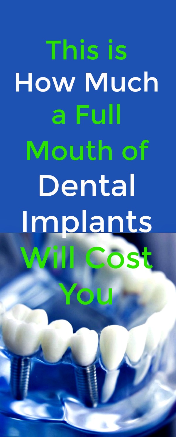 This Is How Much a Full Mouth of Dental Implants Will Cost You - Dental implants are on the rise and many people are becoming interested in them to alter the appearance of their smile in a positive way How many implants are needed for a full mouth? How much does it cost to get a full mouth of dental implants? Find out here. #dental #implants #dentalimplants #dentalcare #teethreplacement #dentalcare This Is How Much a Full Mouth of Dental Implants Will Cost You - Dental implants are on the rise and many people are becoming interested in them to alter the appearance of their smile in a positive way How many implants are needed for a full mouth? How much does it cost to get a full mouth of dental implants? Find out here. #dental #implants #dentalimplants #dentalcare #teethreplacement #dentalcare